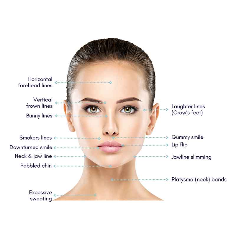 Injectables-face-map-1